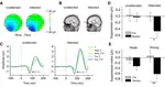 Attention-dependent early cortical suppression contributes to crowding